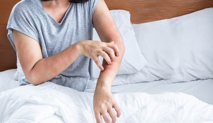 Woman having an allergic skin rash from mold exposure